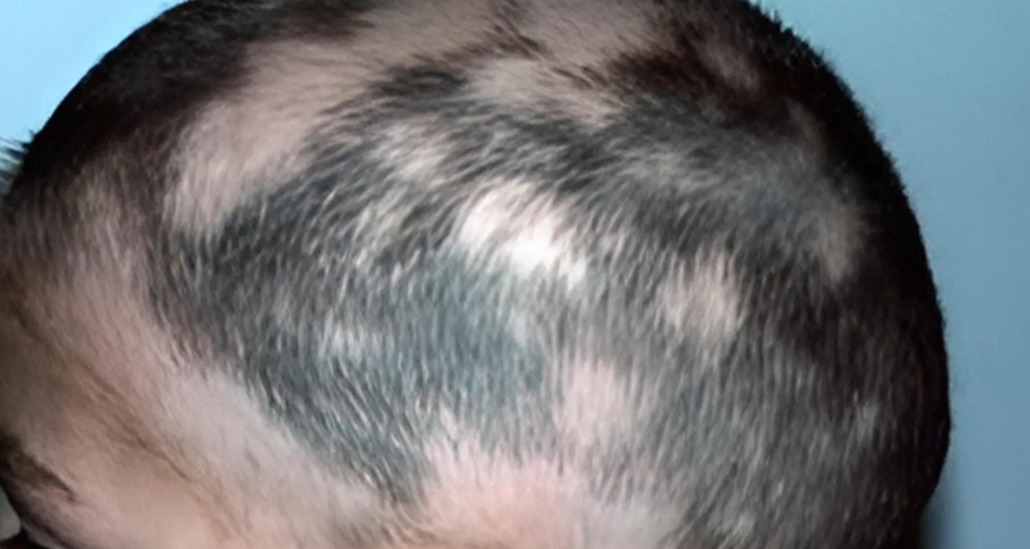 Alopecia Areata in Kids: Understanding, Diagnosing, and Managing Hair Loss