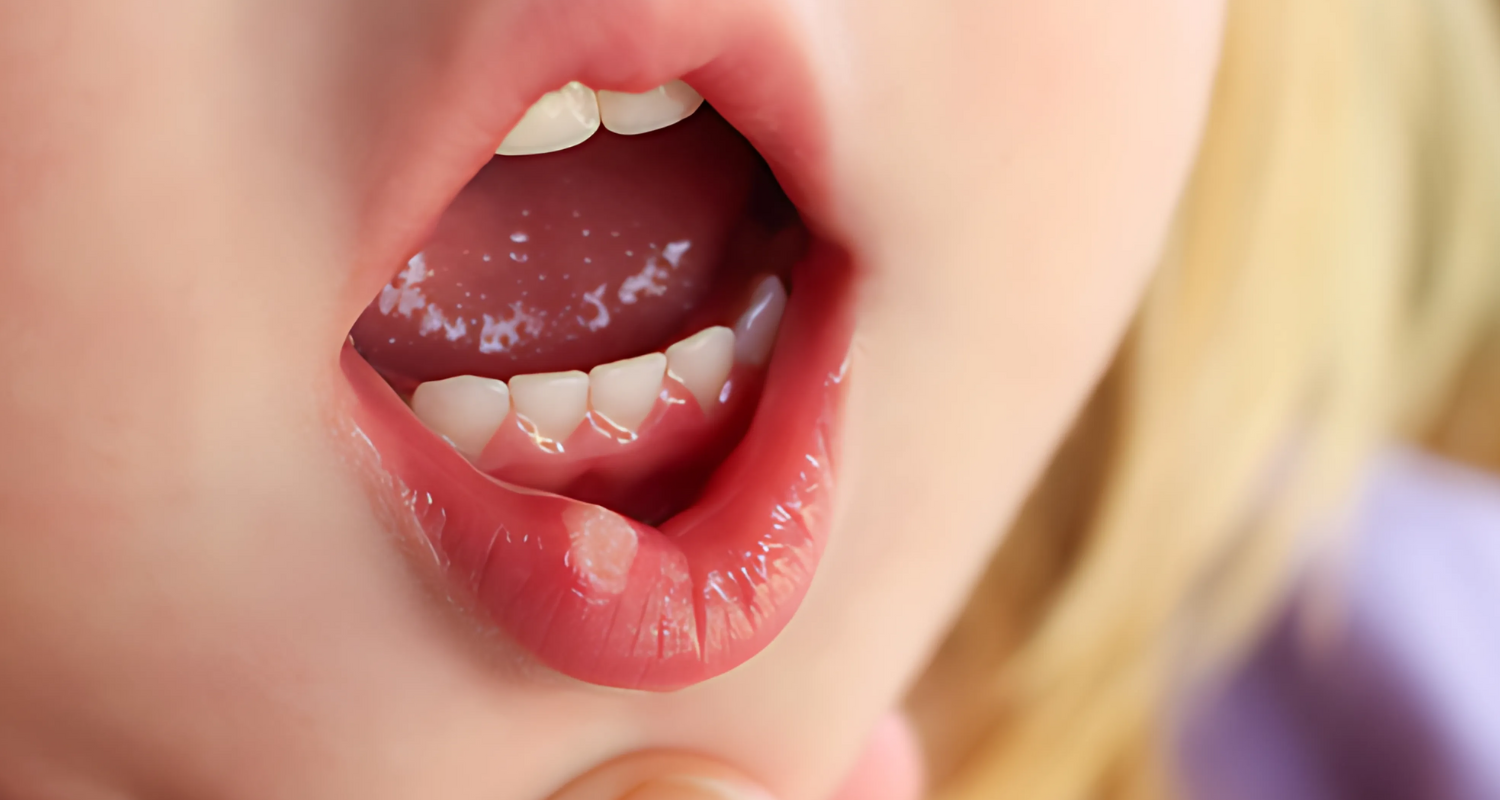 Mouth Ulcers in Babies and Children: Causes, Symptoms, and Treatment